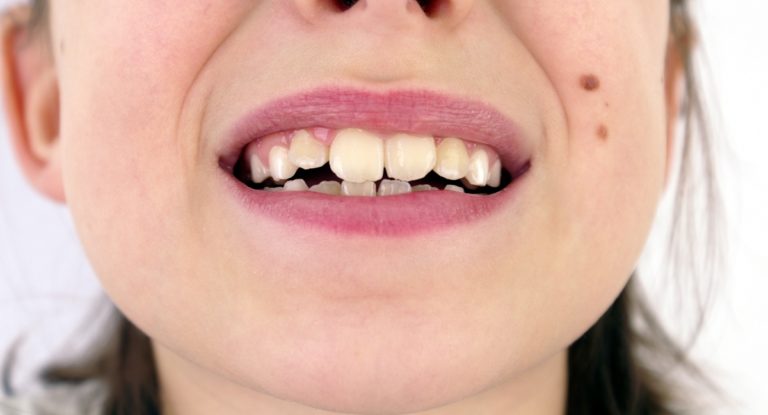 misaligned yellowish teeth