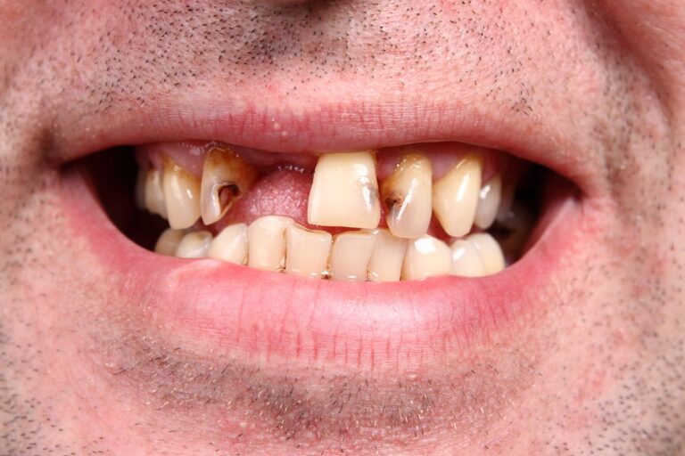 man with tooth loss