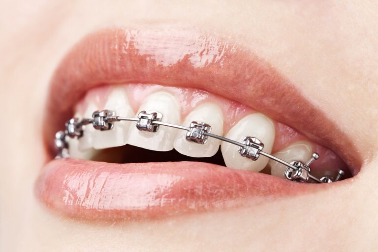 a person wearing braces